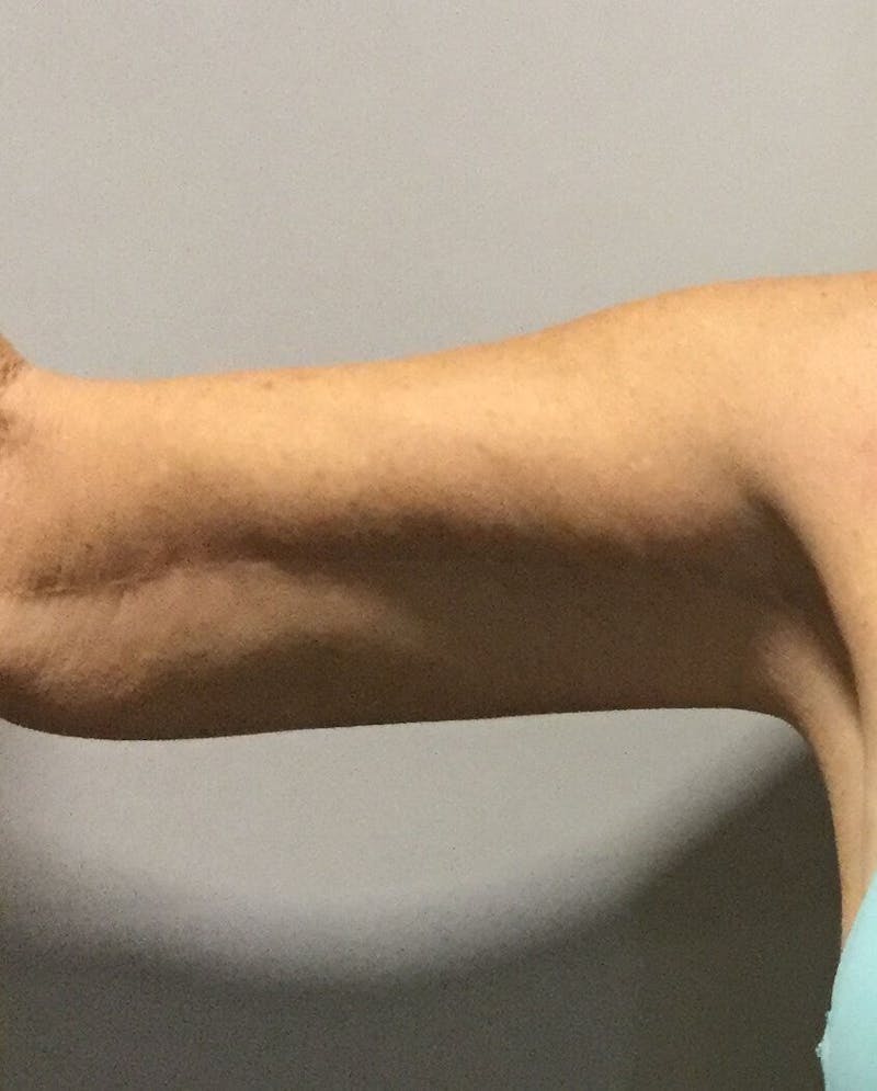 Arm Lift (Brachioplasty) Before & After Gallery - Patient 90401989 - Image 2
