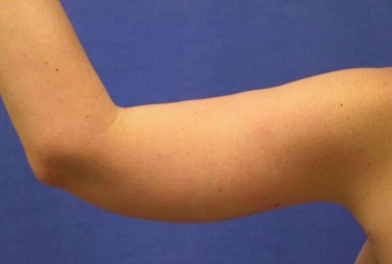 Arm Lift (Brachioplasty) Before & After Gallery - Patient 90401994 - Image 2
