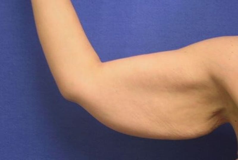 Arm Lift (Brachioplasty) Before & After Gallery - Patient 90401994 - Image 3