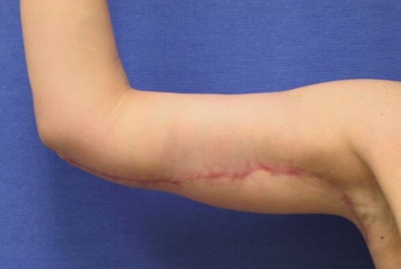 Arm Lift (Brachioplasty) Before & After Gallery - Patient 90401994 - Image 4