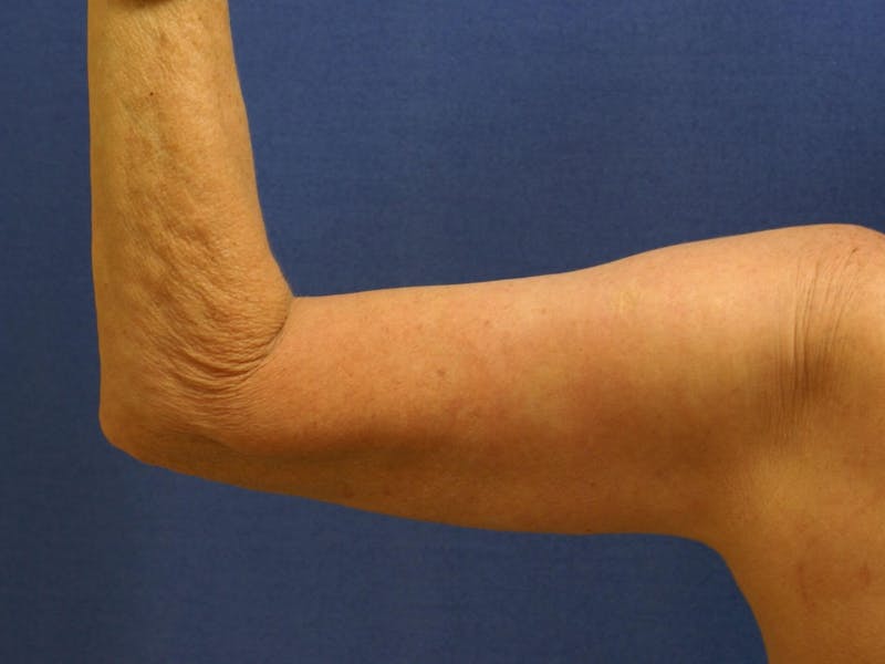 Arm Lift (Brachioplasty) Before & After Gallery - Patient 90402006 - Image 2