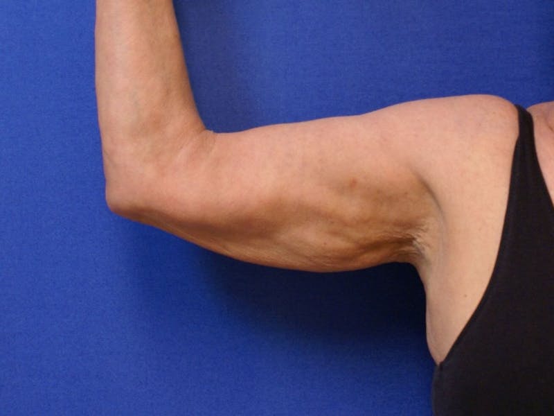 Arm Lift (Brachioplasty) Before & After Gallery - Patient 90402006 - Image 3