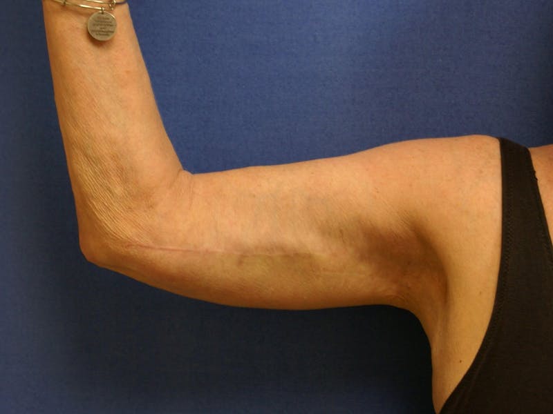 Arm Lift (Brachioplasty) Before & After Gallery - Patient 90402006 - Image 4