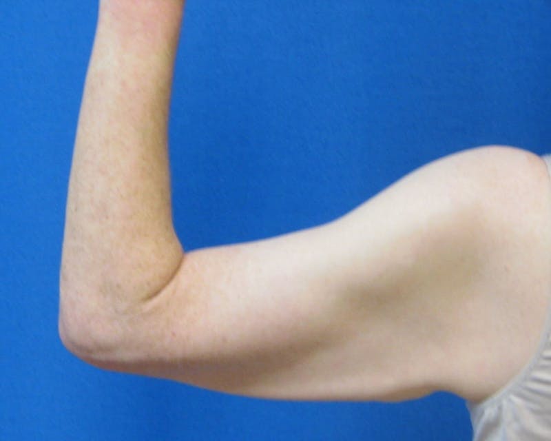 Arm Lift (Brachioplasty) Before & After Gallery - Patient 90402012 - Image 1