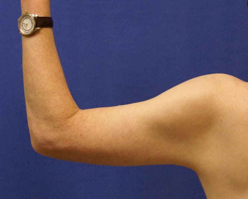Arm Lift (Brachioplasty) Before & After Gallery - Patient 90402012 - Image 2