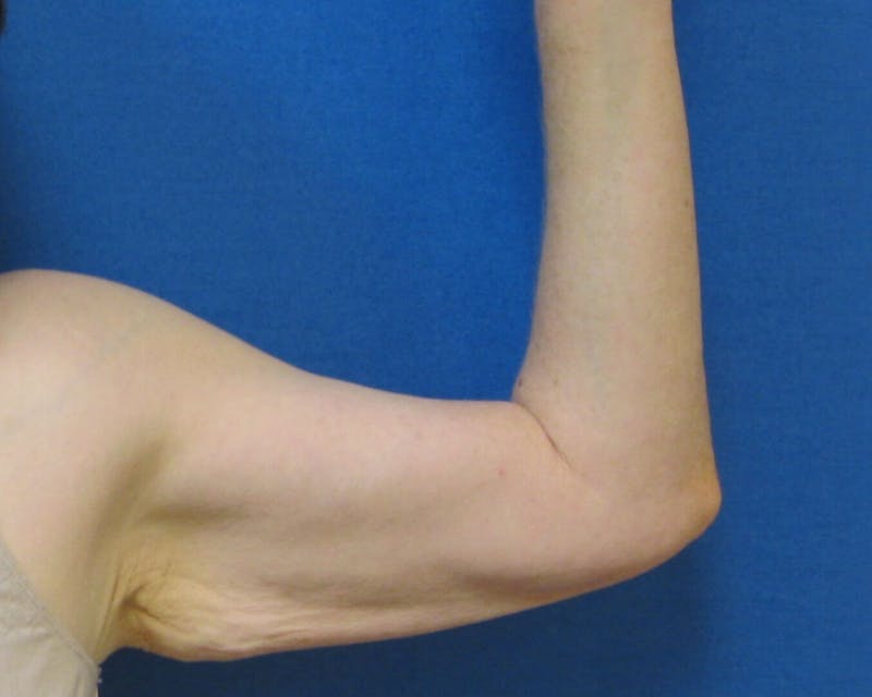 Arm Lift (Brachioplasty) Before & After Gallery - Patient 90402012 - Image 3
