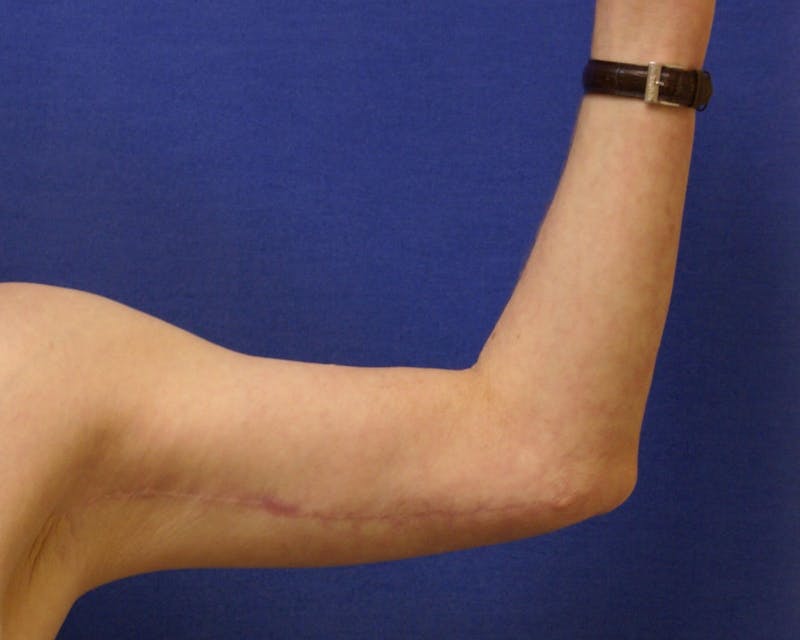 Arm Lift (Brachioplasty) Before & After Gallery - Patient 90402012 - Image 4