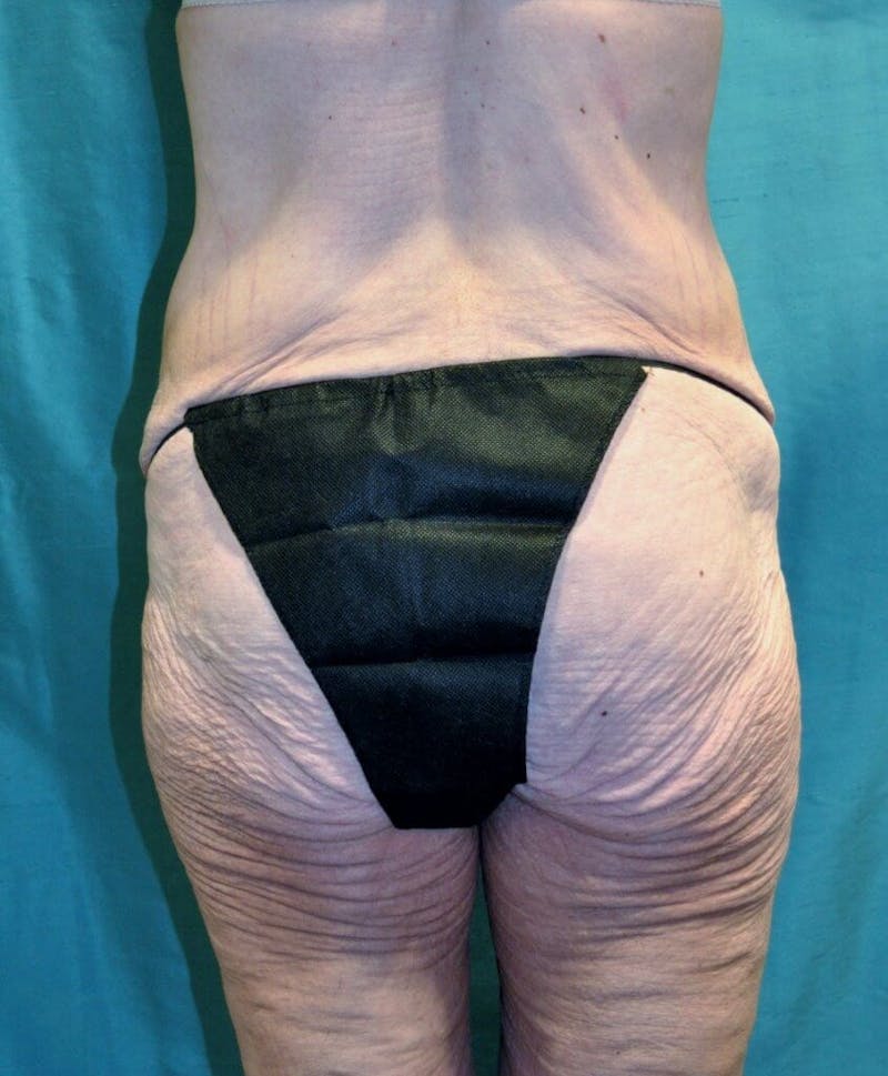 Body Contouring Before & After Gallery - Patient 90402033 - Image 1