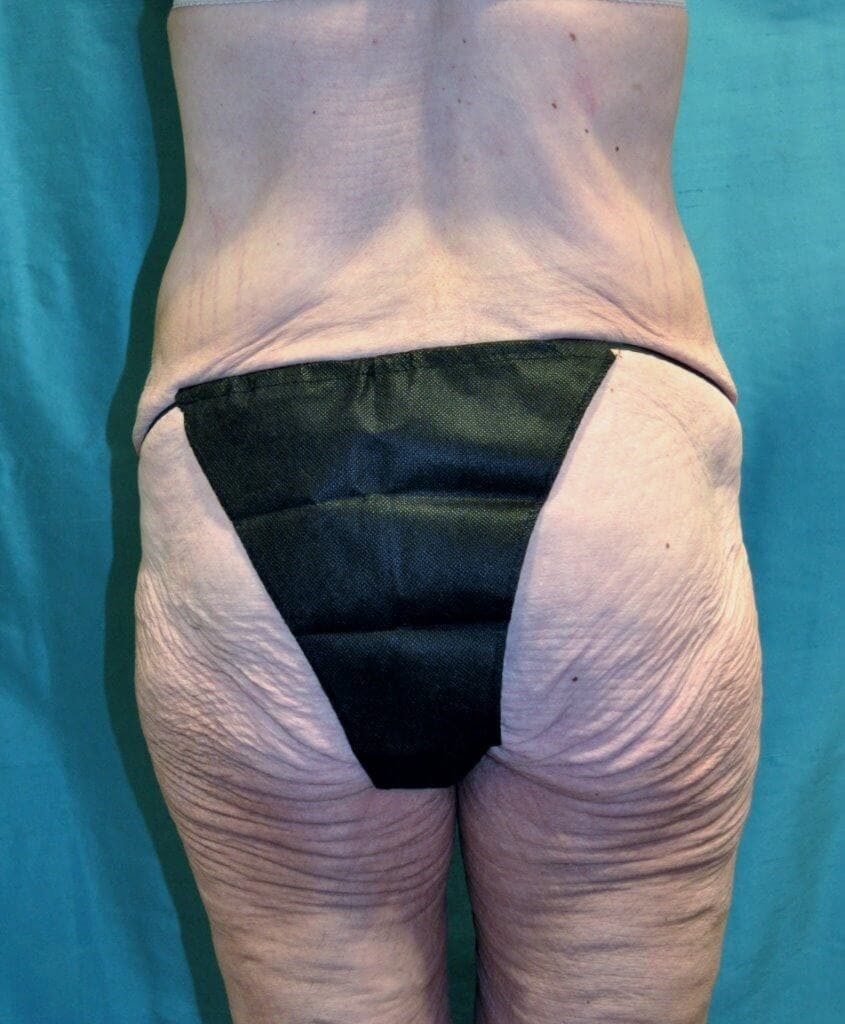 Body Contouring Gallery - Patient 90402033 - Image 1