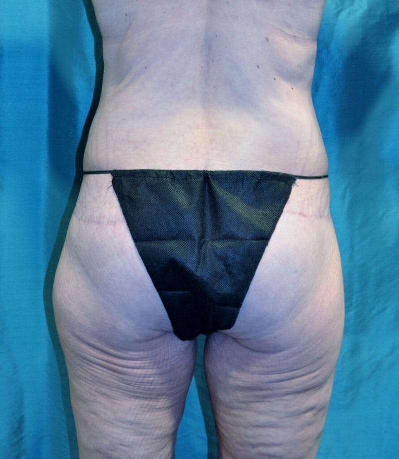 Body Contouring Before & After Gallery - Patient 90402033 - Image 2