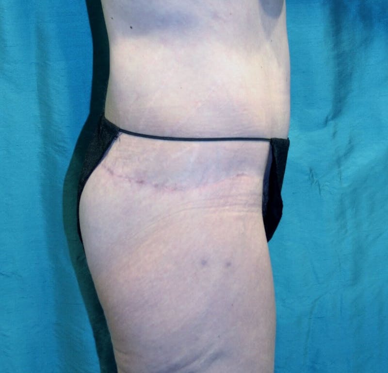 Body Contouring Before & After Gallery - Patient 90402033 - Image 4
