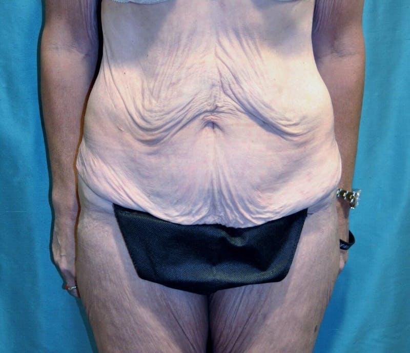 Body Contouring Before & After Gallery - Patient 90402033 - Image 5
