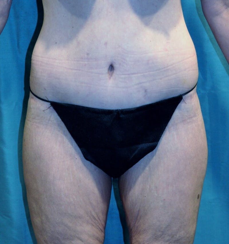 Body Contouring Before & After Gallery - Patient 90402033 - Image 6