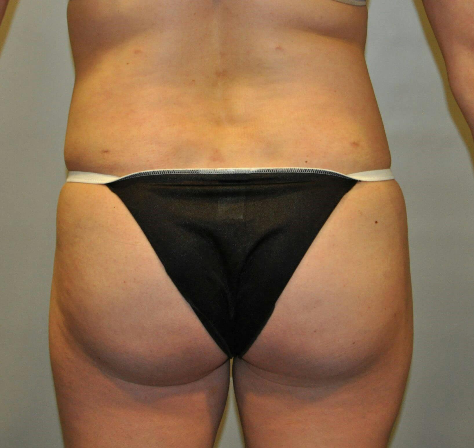 Brazilian Butt Lift Gallery - Patient 90402034 - Image 2