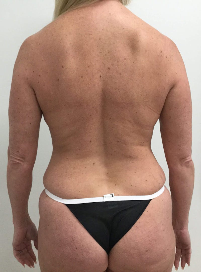 Butt Lift Before & After Gallery - Patient 90402046 - Image 1