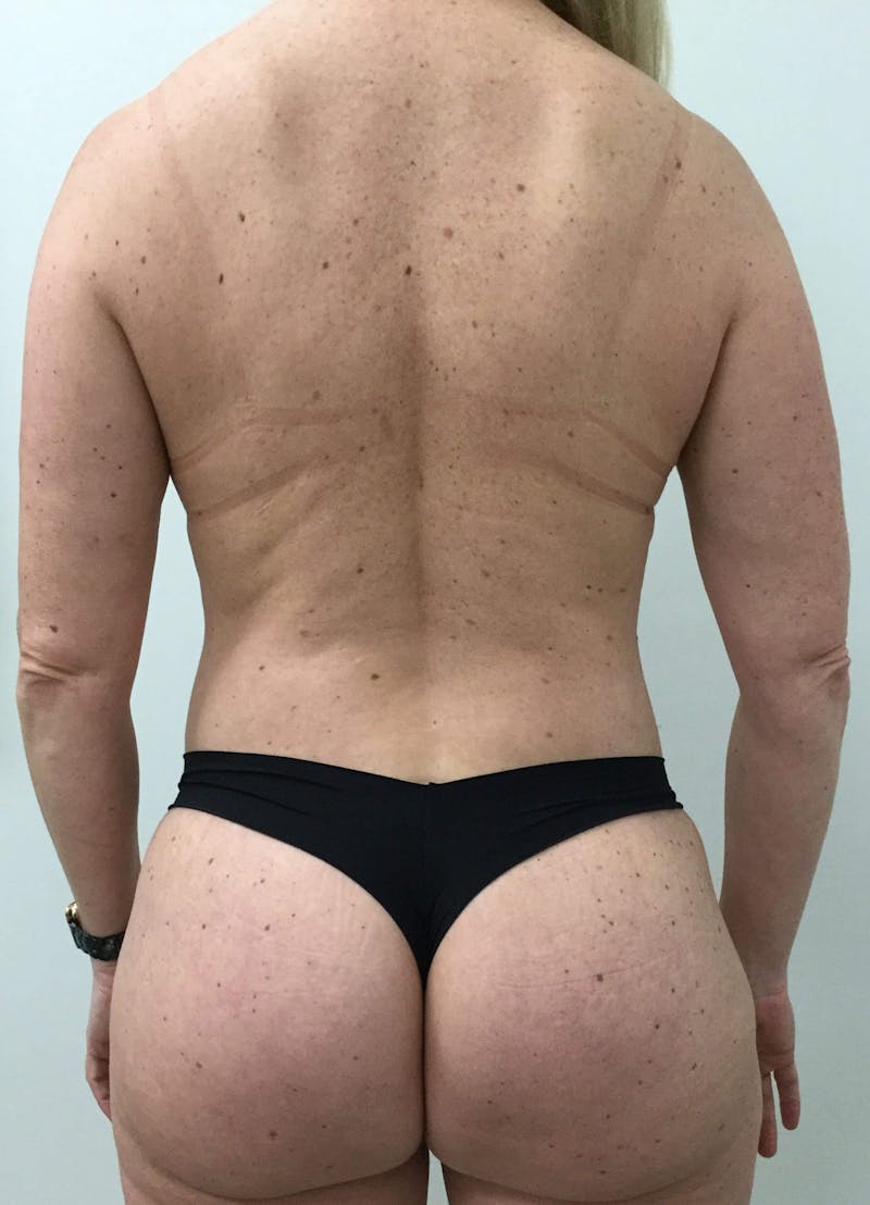 Butt Lift Before & After Gallery - Patient 90402046 - Image 2