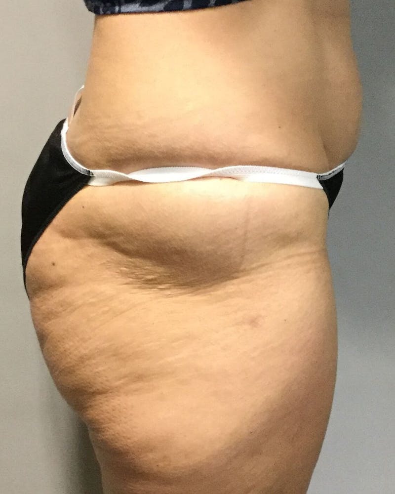 Fat Transfer Before & After Gallery - Patient 90402074 - Image 2