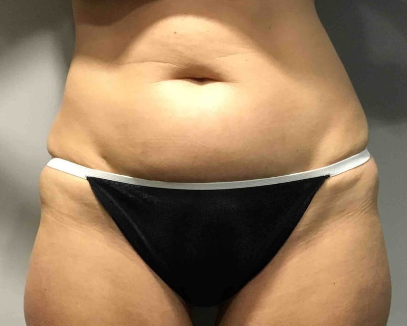Fat Transfer Before & After Gallery - Patient 90402074 - Image 3