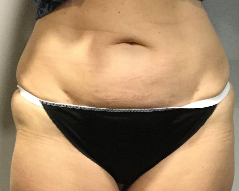 Fat Transfer Before & After Gallery - Patient 90402074 - Image 4