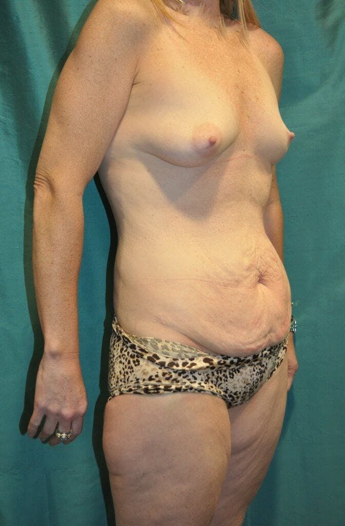 Mommy Makeover Gallery - Patient 90402075 - Image 1