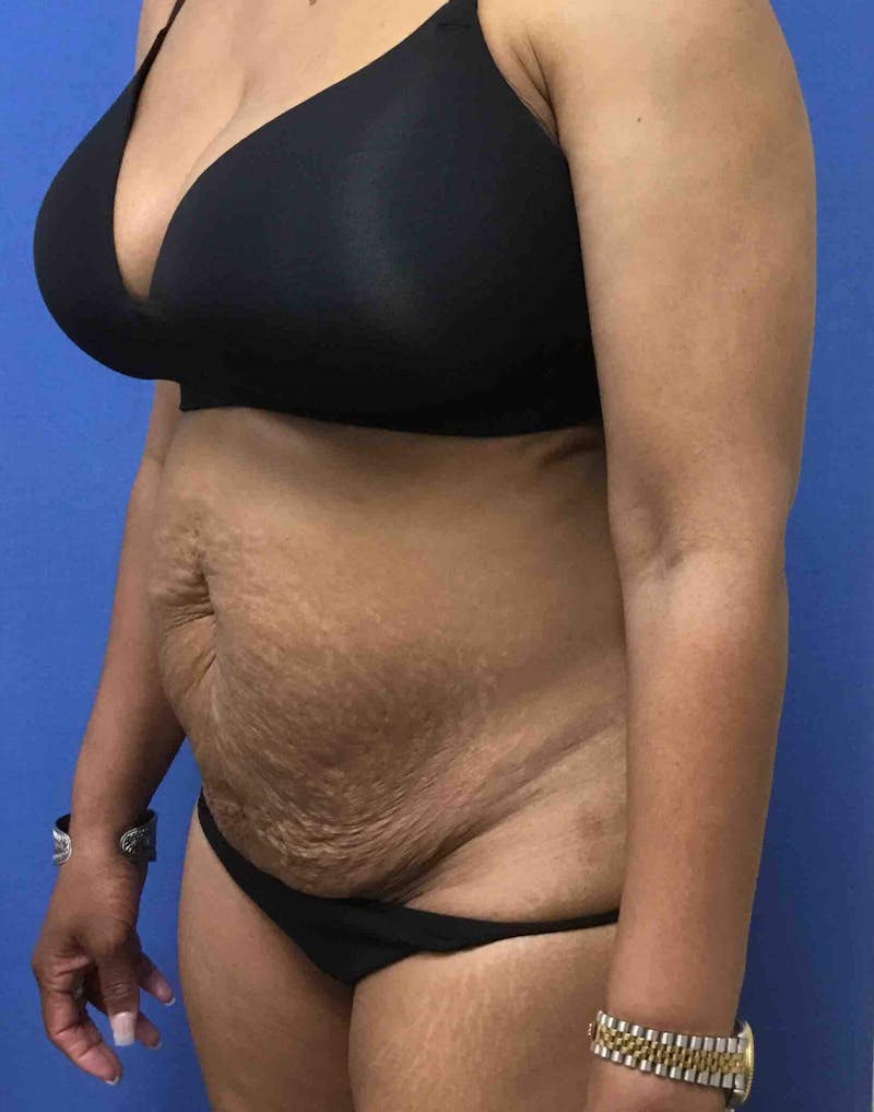 Liposuction Before & After Gallery - Patient 90402593 - Image 3