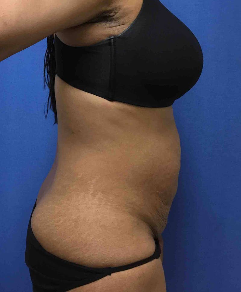 Liposuction Before & After Gallery - Patient 90402593 - Image 7