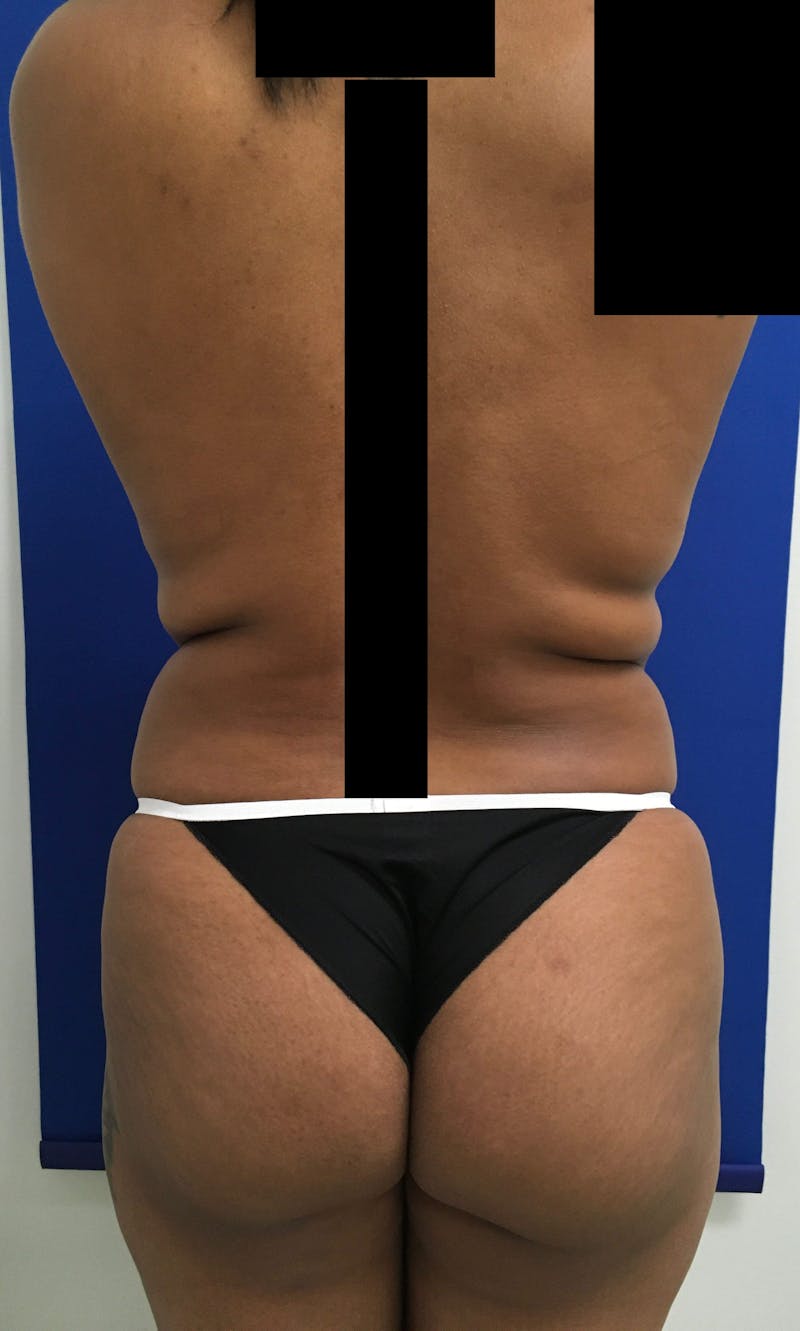 Liposuction Before & After Gallery - Patient 90402605 - Image 3