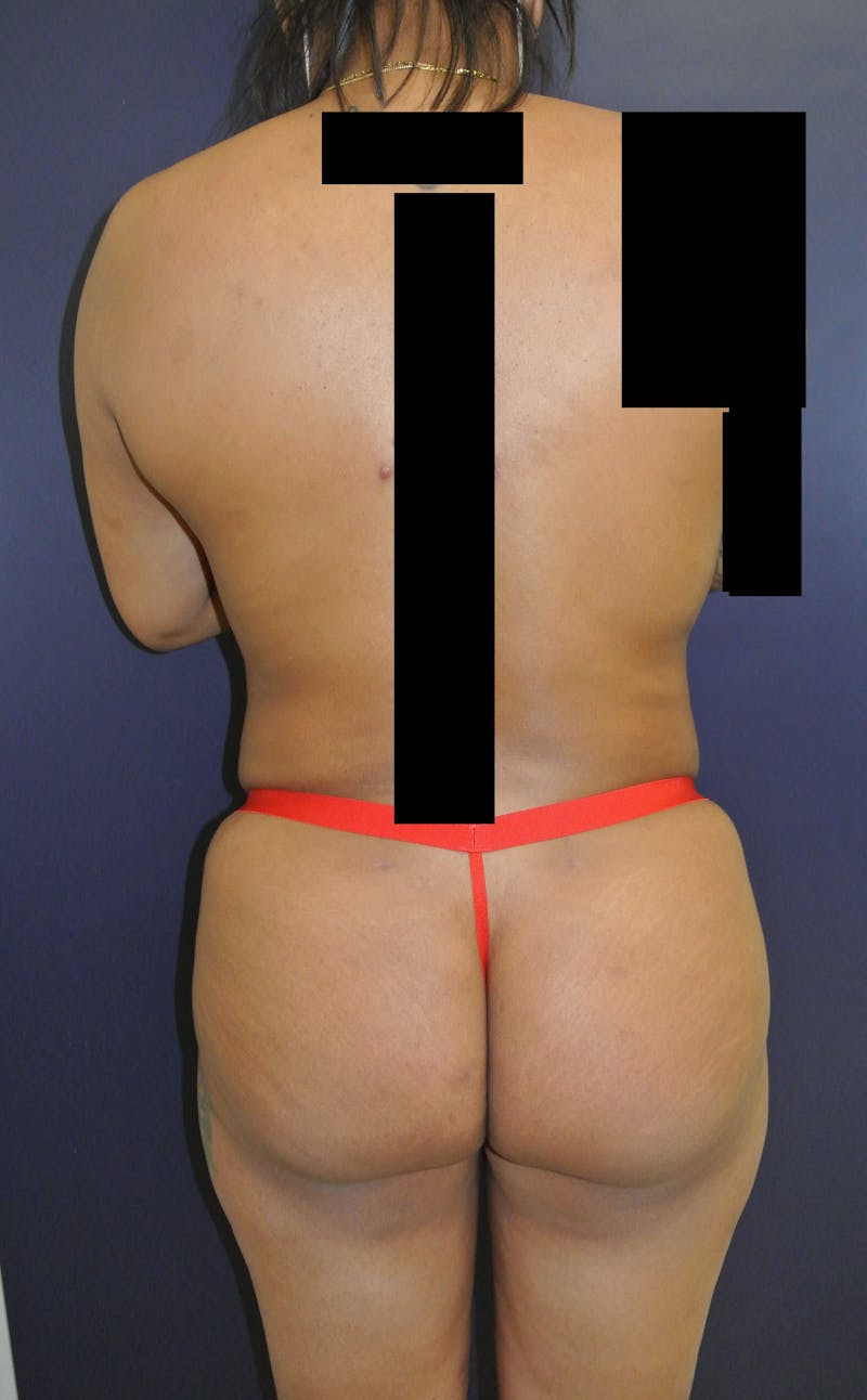 Liposuction Gallery - Patient 90402605 - Image 4