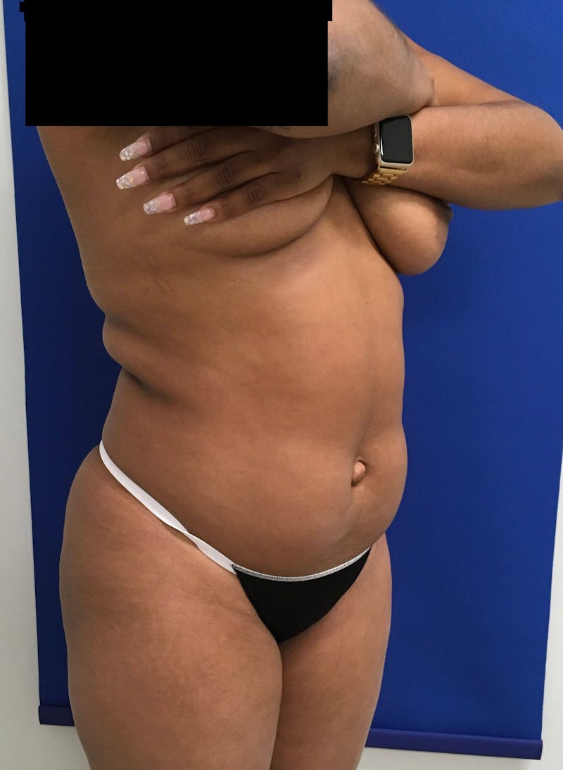 Liposuction Gallery - Patient 90402605 - Image 5