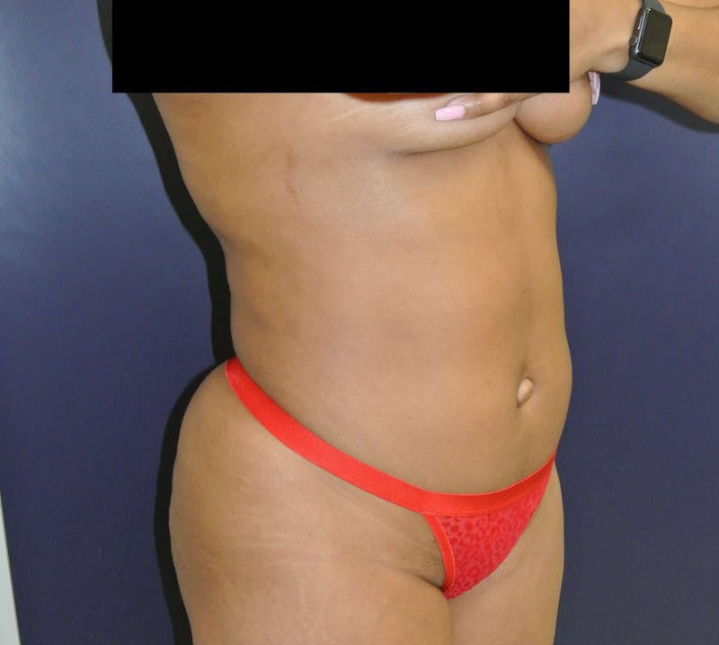 Liposuction Before & After Gallery - Patient 90402605 - Image 6