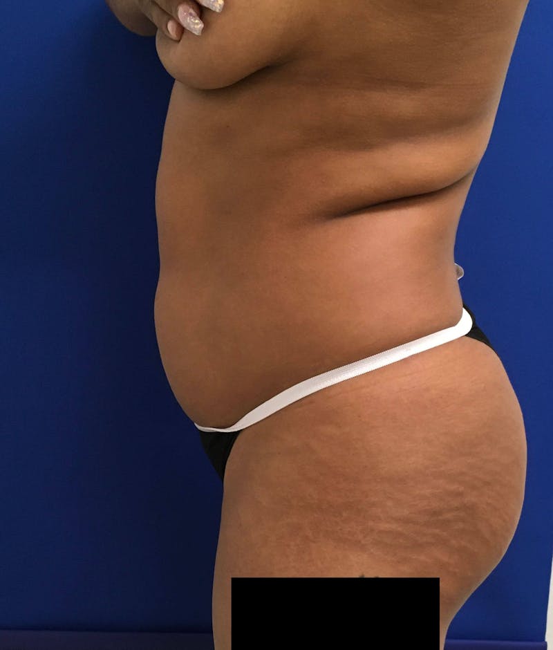 Liposuction Gallery - Patient 90402605 - Image 7