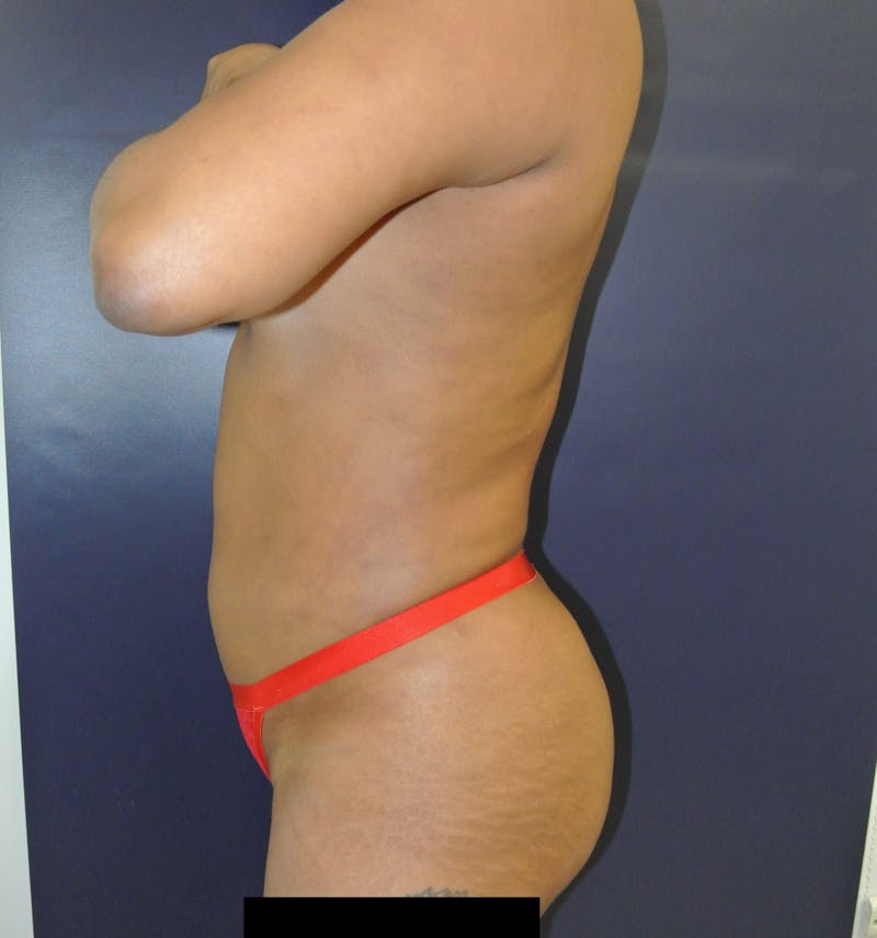 Liposuction Gallery - Patient 90402605 - Image 8