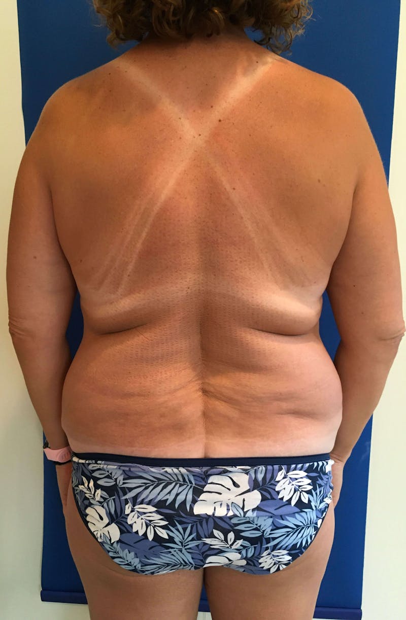 Liposuction Before & After Gallery - Patient 90402612 - Image 1