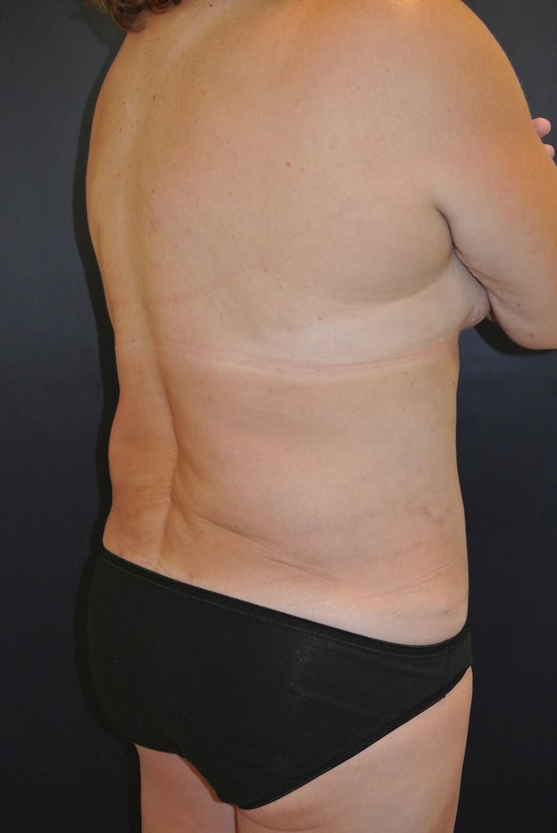 Liposuction Before & After Gallery - Patient 90402612 - Image 4