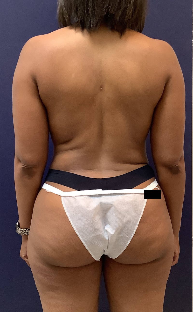Liposuction Before & After Gallery - Patient 90402616 - Image 4