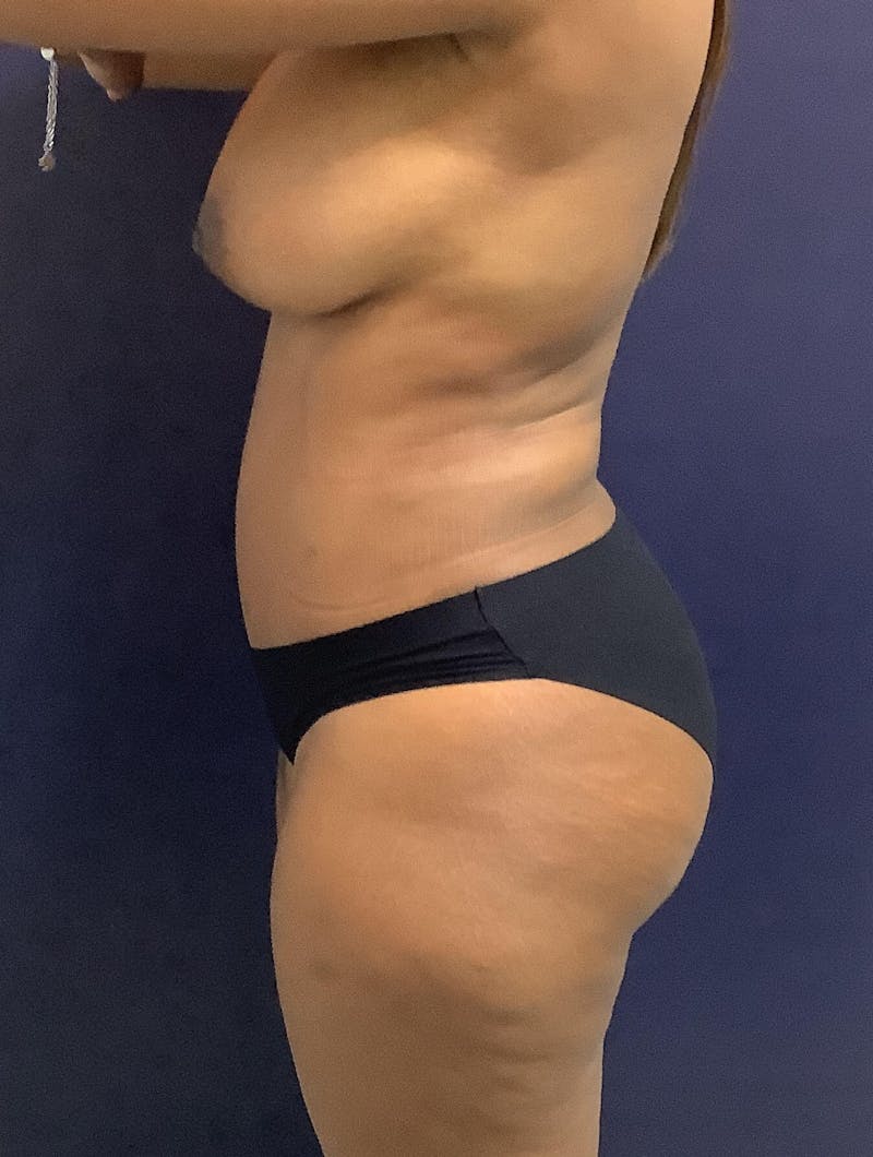 Liposuction Before & After Gallery - Patient 90402616 - Image 6