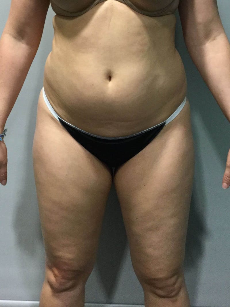 Liposuction Before & After Gallery - Patient 90402673 - Image 1