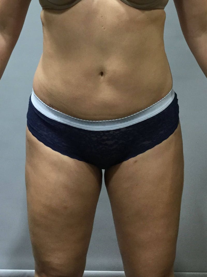 Liposuction Before & After Gallery - Patient 90402673 - Image 2