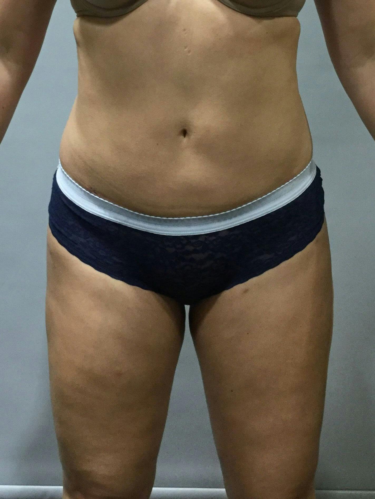 Liposuction Gallery - Patient 90402673 - Image 2