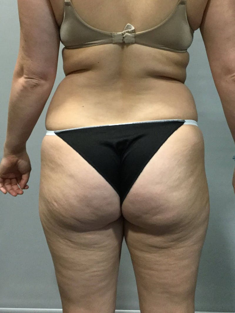 Liposuction Before & After Gallery - Patient 90402673 - Image 3
