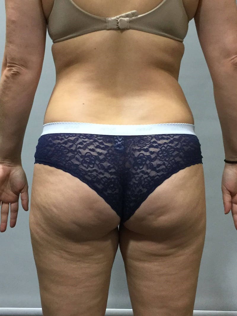 Liposuction Before & After Gallery - Patient 90402673 - Image 4