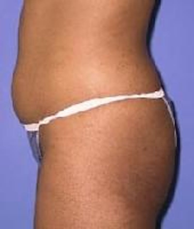 Liposuction Before & After Gallery - Patient 90402675 - Image 1