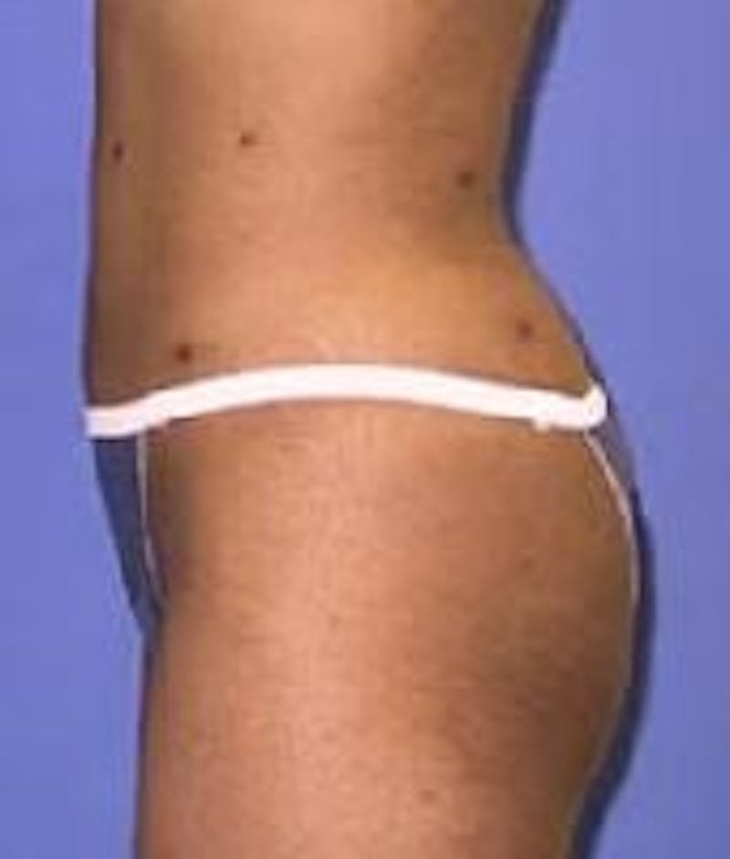 Liposuction Before & After Gallery - Patient 90402675 - Image 2