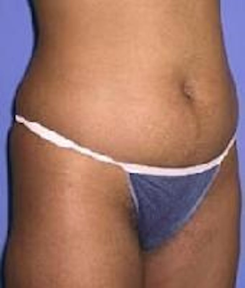 Liposuction Before & After Gallery - Patient 90402675 - Image 3