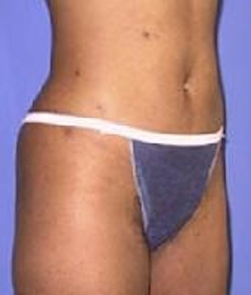 Liposuction Before & After Gallery - Patient 90402675 - Image 4