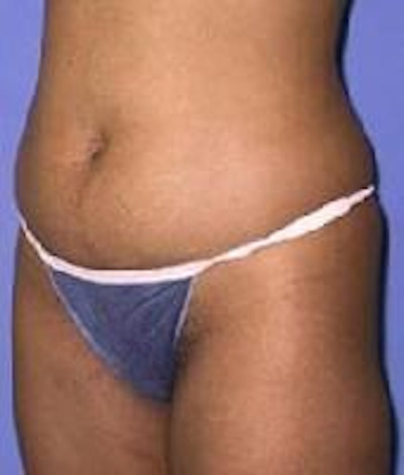 Liposuction Before & After Gallery - Patient 90402675 - Image 5