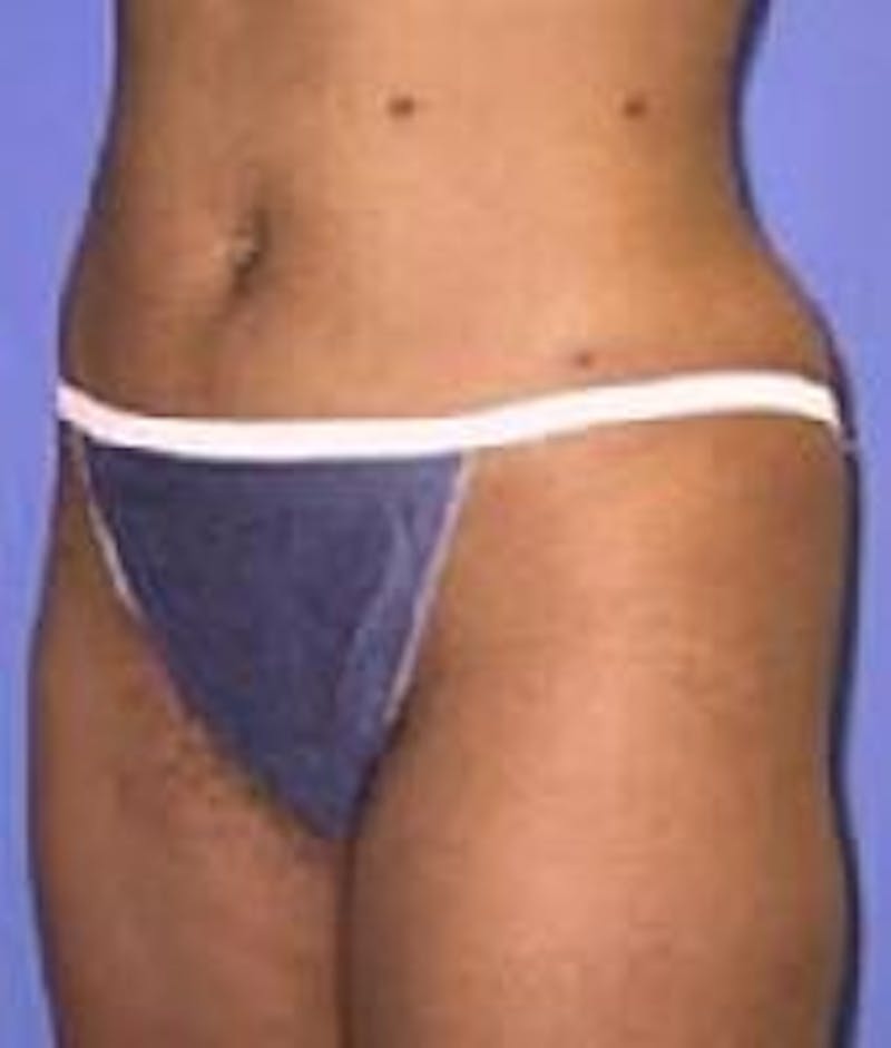 Liposuction Before & After Gallery - Patient 90402675 - Image 6
