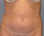 Liposuction Gallery - Patient 90402677 - Image 1