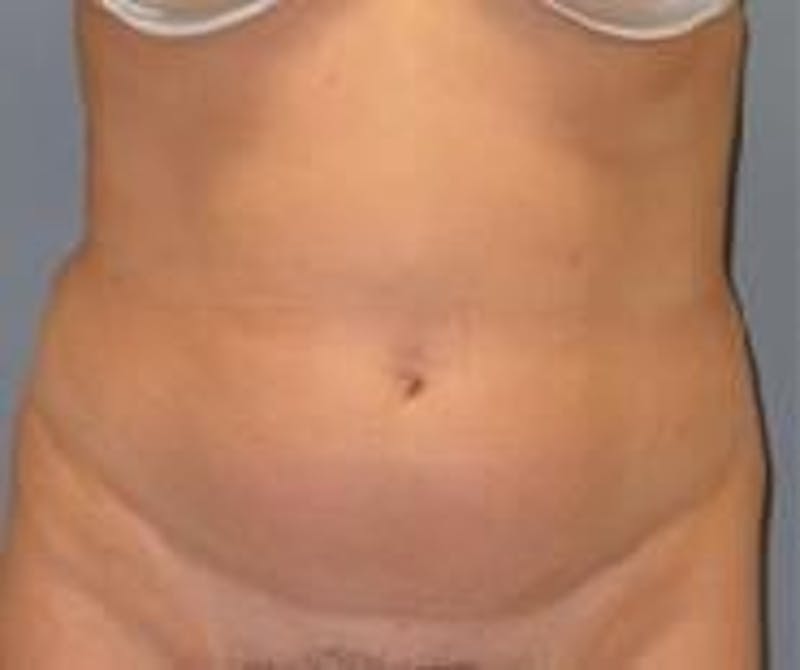 Liposuction Before & After Gallery - Patient 90402677 - Image 1