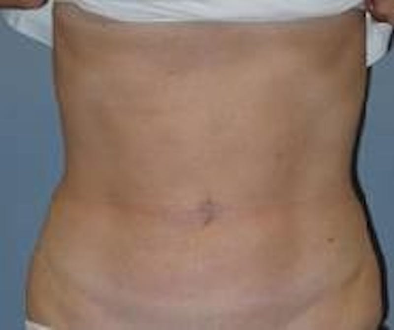 Liposuction Before & After Gallery - Patient 90402677 - Image 2